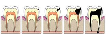 Cavity